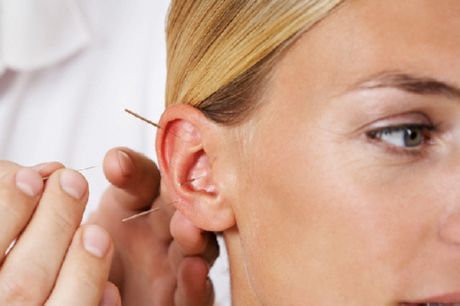 Acupunctură