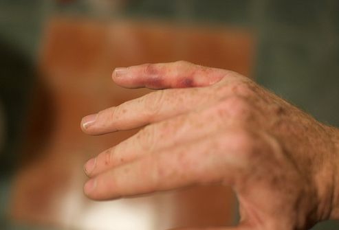 articulațiile mâinilor rănite periodic