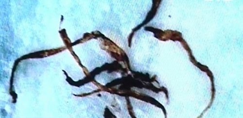 Boala Morgellons există și ar putea fi legată de OMG-uri