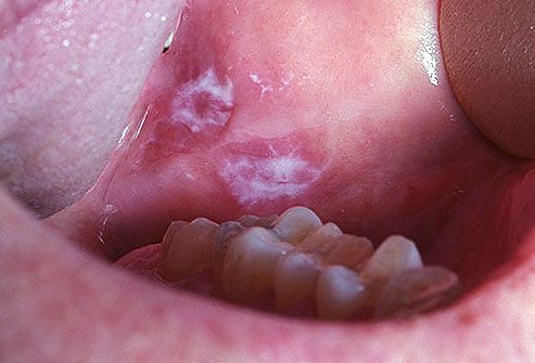 Leucoplazie
