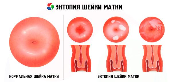 Ectopia colului uterin a negilor. Negi in zona colului uterin Pagina 22