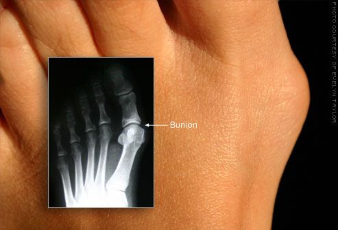 Deformarea bunion vulgus a degetului mare de la picior