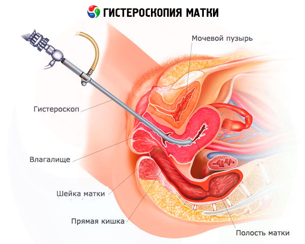 uterine de îndepărtare a polipului și pierderea în greutate)