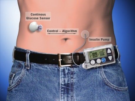 pancreas artificial pentru diabet