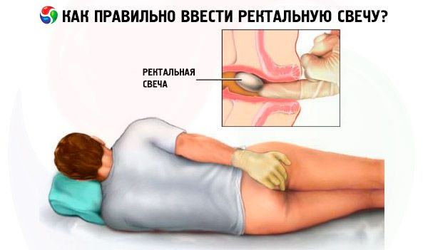 aplicarea supozitoarelor pentru prostatită)