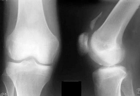 ligatura articulației genunchiului