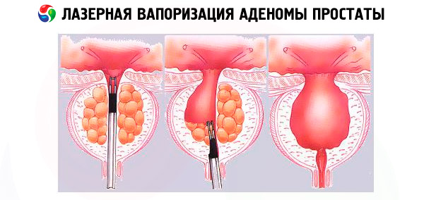 Vaporizarea adenomului de prostată în Institutul de Urologie