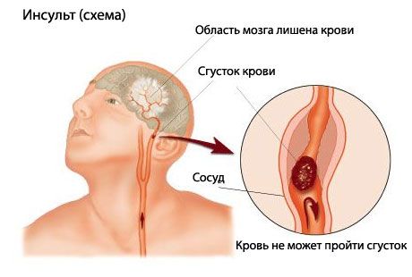 Un test simplu prezice un accident vascular cerebral fatal