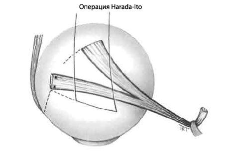 Strabism - Operațiune