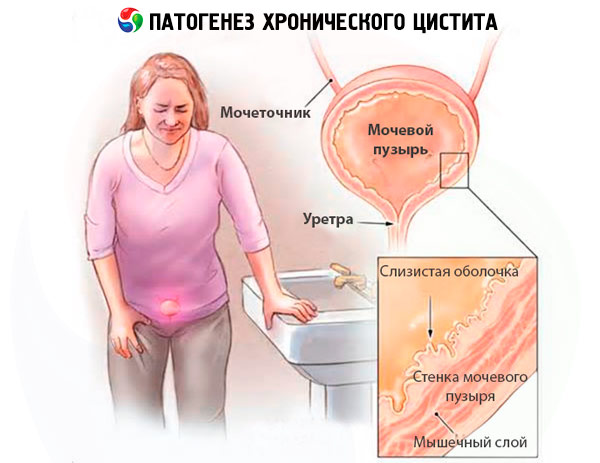 etiologia și patogeneza prostatitei cronice)