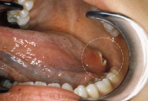 Cancer oral