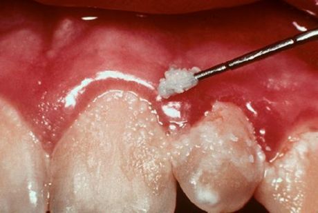 Dinți și gingivită