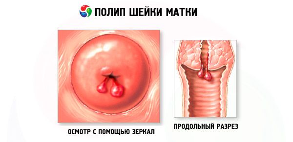 Polip în uter și virusul papilomului