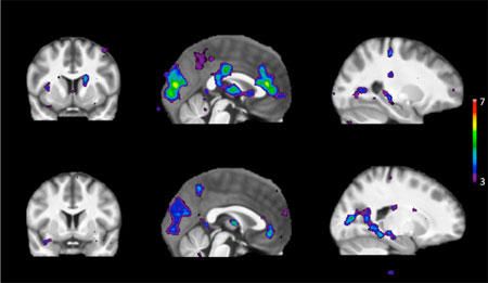 Scanările arată zone de activitate cerebrală ca răspuns la stimuli la persoanele care metabolizează rapid nicotina (rândul de sus) și la persoanele care metabolizează lent nicotina (rândul de jos)