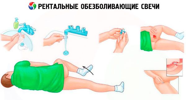 supozitoare anestezice pentru prostatită)