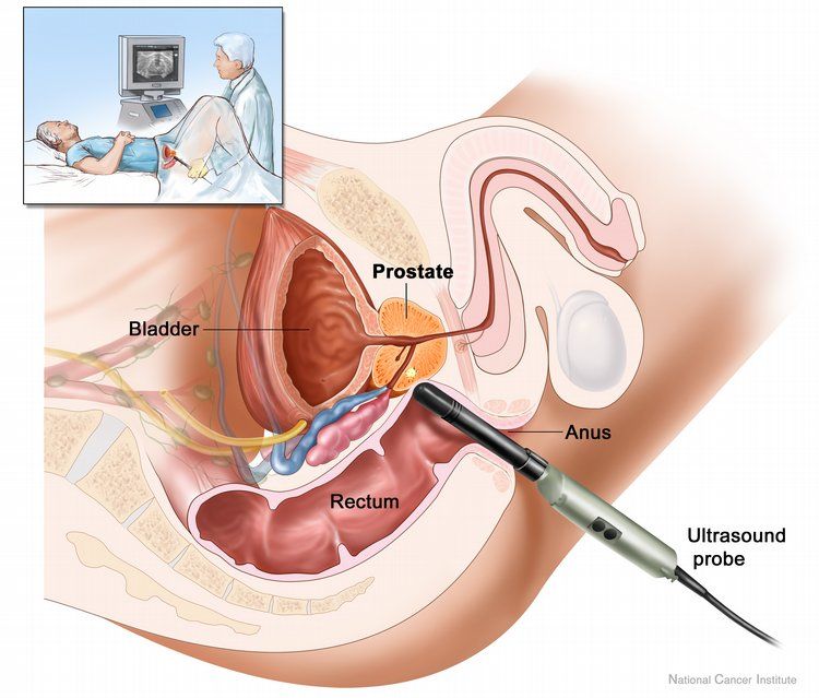 Un medicament eficient împotriva cancerului de prostată a fost creat pe bază de ceai și aur.