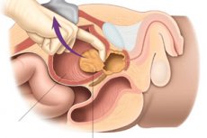 consecințele intervenției chirurgicale a adenomului de prostată din bulionul de prostatită