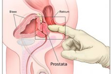 eficacitatea masajului prostatei în prostatita cronică)
