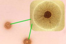 mycoplasma hominis și prostatita tratamentul la domiciliu al adenomului de prostatita