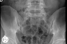 radiografie articulatii sacroiliace