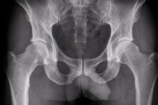radiografie bazin normala refacerea articulației gleznei după fractura piciorului