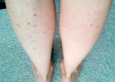 Puncte negre pe picioare în varicoză