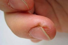 Fisuri ale degetelor de la picioare - cauze și tratament - Profilaxie