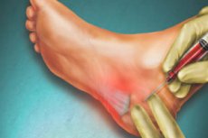 tratamentul artritei artrozei genunchiului medicamente care conțin condroitină glucozamină