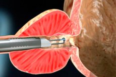 vaporizarea cu laser a adenomului de prostată prostatic abscess symptoms