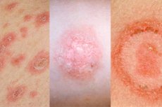 Puncte sau pete roșii pe față - cauze și tratament