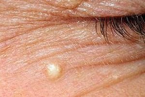 De ce poate apărea o fâșie dureroasă pe fesele de sub piele?