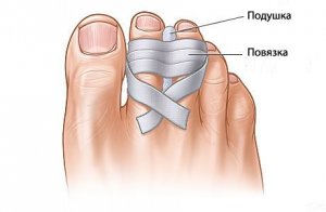 artrita fractura de deget de la picior)