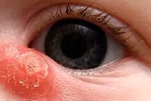 inflamația oftalmologiei sacului lacrimal goji pentru vedere