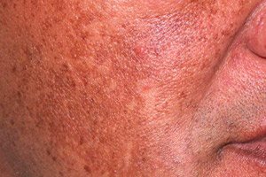 hiperpigmentarea pielii sunt ouă anti-îmbătrânire