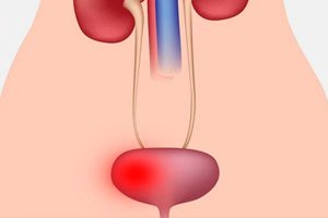 sânge în urină cu prostatita și adenom volume prostata a 50 anni