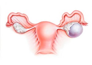 pierderea în greutate după ruperea chisturilor ovariene pierderea grăsimilor în menopauză