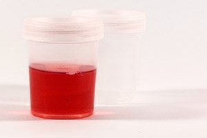urină roșie cu prostatită)