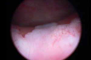 refacerea mucoasei vezicii urinare nisip rinichi
