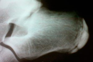 Boli ale articulațiilor picioarelor osteomielită
