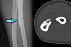 osteomul bolilor osoase și articulare cele mai eficiente unguente pentru tratamentul artrozei