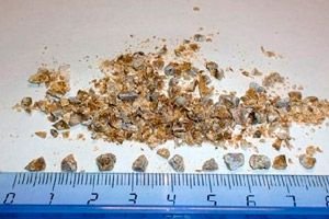 Cum să identificați și să eliminați nisipul din rinichi - Simptome November