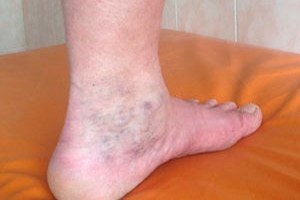 scleroterapie de tratament cu varicoză puncte pe picioare cu fotografii varicoase