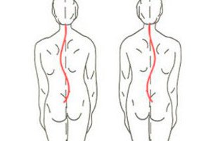 Scolioza - cum se corectează curbura coloanei vertebrale - Cifoză - 