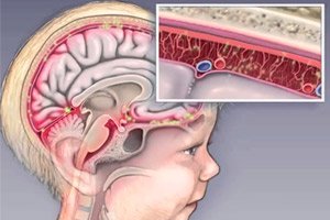 viziune după meningoencefalită)