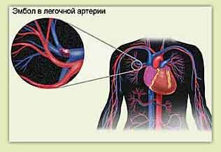 Embolismul pulmonar și durerile toracice din stânga