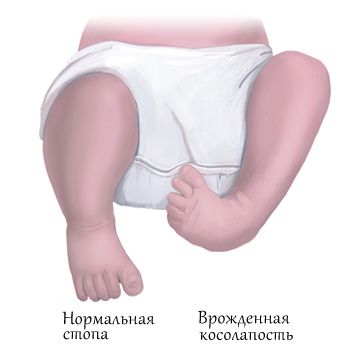 Tratamentul piciorului fără intervenție chirurgicală