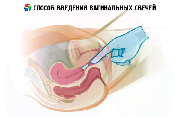 Neo-Anuzol de prostată